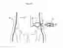Fig. 133 - Apparatus for controlling flow in a bodily organ