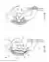 Fig. 143 - Apparatus for controlling flow in a bodily organ
