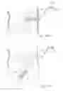 Fig. 17 - Apparatus for controlling flow in a bodily organ