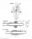 Fig. 170 - Apparatus for controlling flow in a bodily organ
