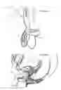 Fig. 47 - Apparatus for controlling flow in a bodily organ