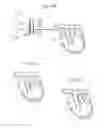 Fig. 51 - Apparatus for controlling flow in a bodily organ