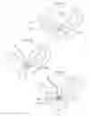 Fig. 62 - Apparatus for controlling flow in a bodily organ