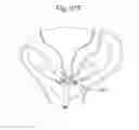 Fig. 63 - Apparatus for controlling flow in a bodily organ