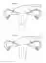 Fig. 68 - Apparatus for controlling flow in a bodily organ