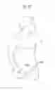 Fig. 70 - Apparatus for controlling flow in a bodily organ