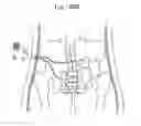 Fig. 83 - Apparatus for controlling flow in a bodily organ