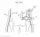 Fig. 94 - Apparatus for controlling flow in a bodily organ