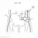 Fig. 95 - Apparatus for controlling flow in a bodily organ