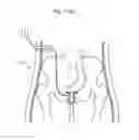 Fig. 96 - Apparatus for controlling flow in a bodily organ