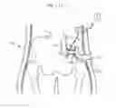 Fig. 97 - Apparatus for controlling flow in a bodily organ