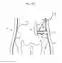 Fig. 98 - Apparatus for controlling flow in a bodily organ