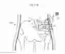 Fig. 99 - Apparatus for controlling flow in a bodily organ