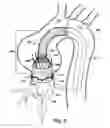 Fig. 07 - Method and apparatus for time-differential deployment of an endovascular device within a body lumen