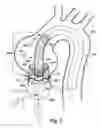 Fig. 08 - Method and apparatus for time-differential deployment of an endovascular device within a body lumen