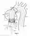 Fig. 09 - Method and apparatus for time-differential deployment of an endovascular device within a body lumen