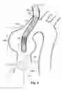 Fig. 10 - Method and apparatus for time-differential deployment of an endovascular device within a body lumen