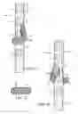 Fig. 03 - Branched vessel endoluminal device