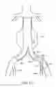 Fig. 15 - Branched vessel endoluminal device