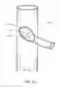 Fig. 23 - Branched vessel endoluminal device