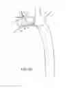 Fig. 32 - Branched vessel endoluminal device