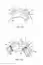 Fig. 33 - Branched vessel endoluminal device