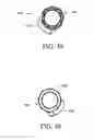 Fig. 36 - Branched vessel endoluminal device