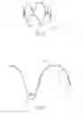 Fig. 04 - Low profile non-symmetrical stent