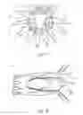 Fig. 11 - Low profile non-symmetrical stent