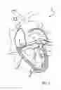 Fig. 02 - Double basket assembly for valve repair