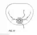Fig. 13 - Double basket assembly for valve repair