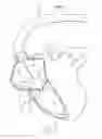 Fig. 09 - Systems and methods for treating a regurgitant heart valve