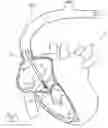 Fig. 10 - Systems and methods for treating a regurgitant heart valve