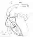 Fig. 11 - Systems and methods for treating a regurgitant heart valve