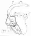 Fig. 12 - Systems and methods for treating a regurgitant heart valve