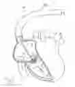 Fig. 13 - Systems and methods for treating a regurgitant heart valve