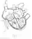 Fig. 14 - Systems and methods for treating a regurgitant heart valve