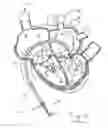 Fig. 15 - Systems and methods for treating a regurgitant heart valve