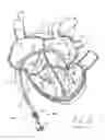 Fig. 16 - Systems and methods for treating a regurgitant heart valve