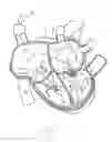 Fig. 18 - Systems and methods for treating a regurgitant heart valve