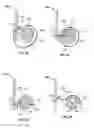 Fig. 09 - Transcatheter valve with paravalvular leak sealing ring
