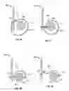 Fig. 10 - Transcatheter valve with paravalvular leak sealing ring