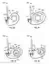 Fig. 13 - Transcatheter valve with paravalvular leak sealing ring