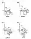 Fig. 16 - Transcatheter valve with paravalvular leak sealing ring