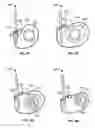 Fig. 17 - Transcatheter valve with paravalvular leak sealing ring