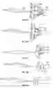 Fig. 20 - Transcatheter valve with paravalvular leak sealing ring