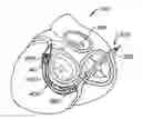 Fig. 01 - Mitral valve annuloplasty device with twisted anchor