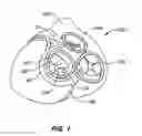 Fig. 02 - Mitral valve annuloplasty device with twisted anchor