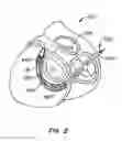 Fig. 03 - Mitral valve annuloplasty device with twisted anchor