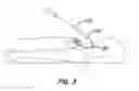 Fig. 04 - Mitral valve annuloplasty device with twisted anchor
